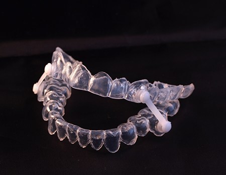 Photo of oral appliance