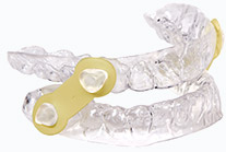 The E M A sleep apnea oral appliance