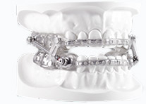 The S U A D sleep apnea oral appliance