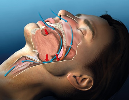 Diagram showing narrow airway that causes snoring