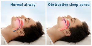 Comparison of sleep apnea and normal airway