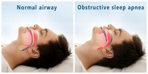 Comparison of sleep apnea and normal airway