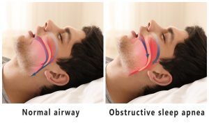 Comparison of normal airway and sleep apnea